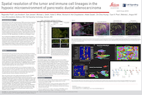 AACR23ポスター 膵臓腺がん 腫瘍・免疫細胞系統の空間解像度 200px