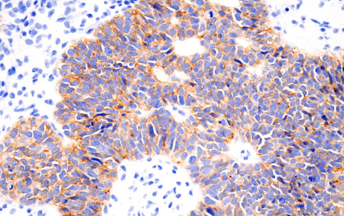 Claudin-6を用いた、ヒト卵巣漿液性乳頭状腺がん組織のIHC解析