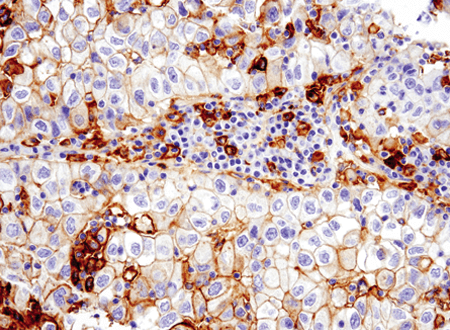 PD-L1を用いたヒト非小細胞肺がんのIHC解析