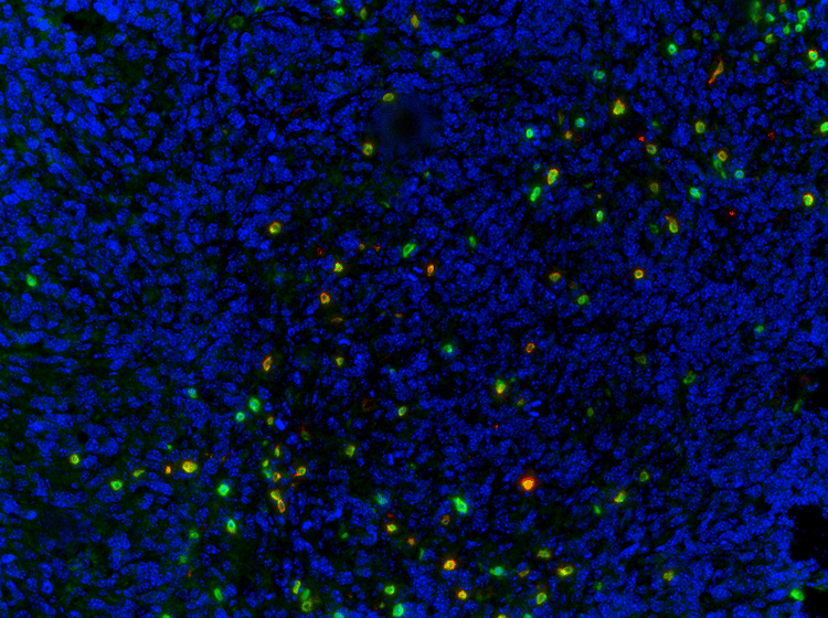 Mouse 4T1 lung metastasis probed with CD3 and CD8