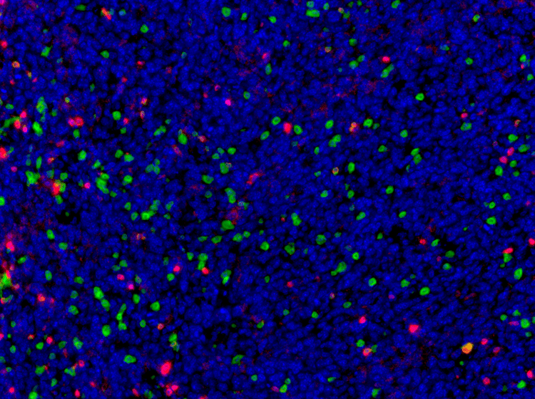 Mouse 4T1 lung metastasis probed with CD8 and CD3