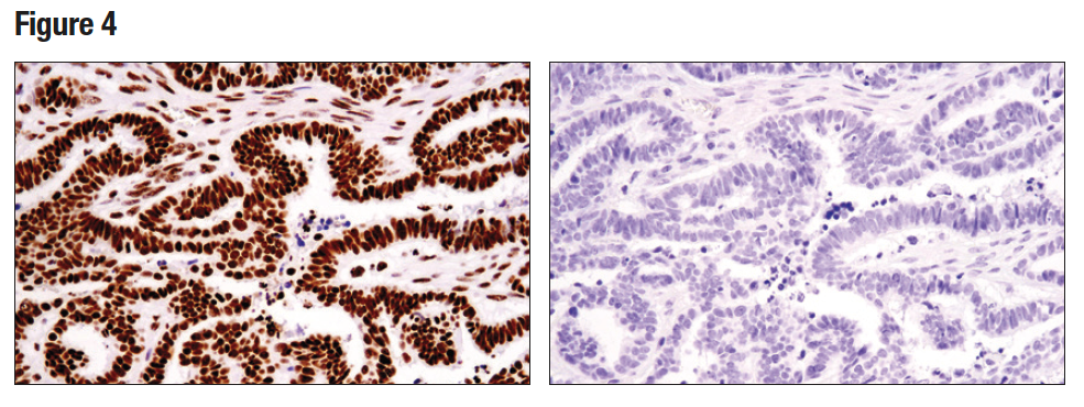 Tri-Methyl-Histone H3 (Lys36) (D5A7) を用いてパラフィン包埋ヒト卵巣漿液性乳頭状腺がん組織をHC解析しました。