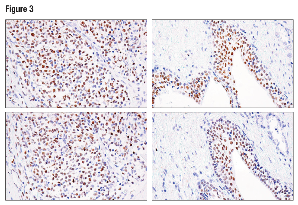 パラフィン包埋したヒトB細胞非ホジキンリンパ腫 (左) および前立腺がん (右) を、Helios (E4L5U) (上) あるいはHelios抗体 (下) を用いて免疫組織化学染色で解析しました。