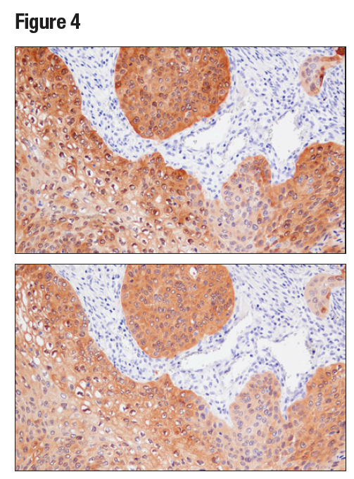 パラフィン包埋したヒト扁平上皮肺がんを、MAGE-A4 (E7O1U) (上) あるいはMAGE-A4抗体 (下) を用いて免疫組織化学染色で解析しました。