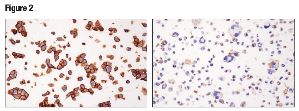 パラフィン包埋したRT4細胞ペレット (左) およびHDLM-2細胞ペレット (右) を、Nectin-2/CD112 (D8D3F) を用いて免疫組織化学染色で解析しました。
