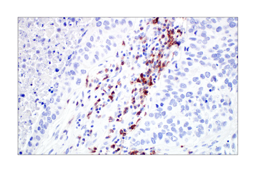 ヒト非小細胞肺がんにおけるTIGIT陽性細胞のIHC