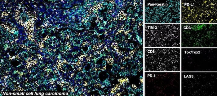パラフィン包埋ヒト非小細胞肺上皮性悪性腫瘍のSignalStar™マルチプレックス免疫組織化学染色解析
