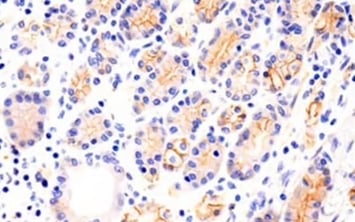 N-Cadherin AntibodyとEMTマーカーを用いた胃がんのIHC解析