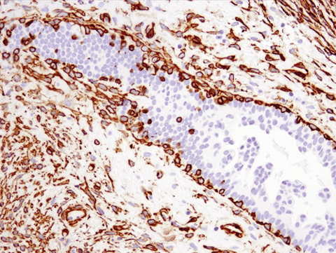 上皮間葉転換マーカーであるα-Smooth Muscle Actin Antibodyを用いた乳がん組織のIHC解析