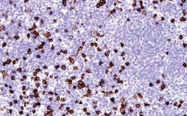 85336_CD8抗体を使った細胞障害性T細胞のIHC解析