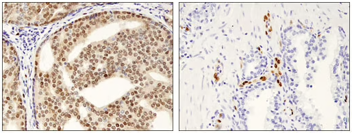 ERG prostate cancer IHC analysis_cropped