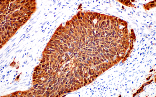 p16 INK4Aを用いた、ヒト子宮頸部の扁平細胞がんのIHC解析