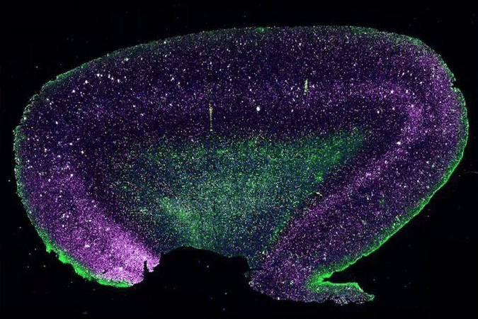 ヒトアルツハイマー脳組織の空間生物学